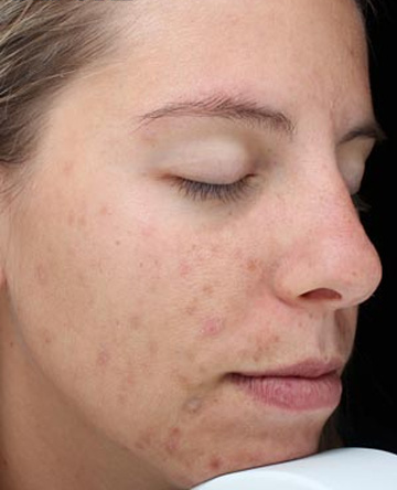 Vi Peels Before & After