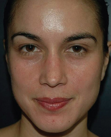 Vi Peels Before & After