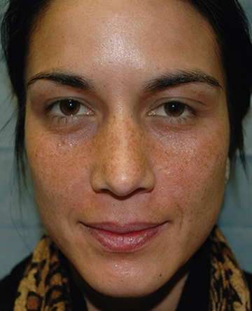 Vi Peels Before & After