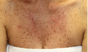 Vi Peels Before & After