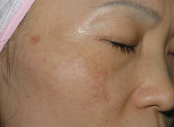 Vi Peels Before & After