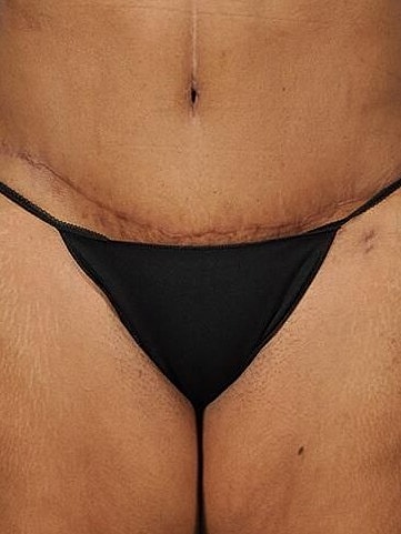 Body Lift Before & After