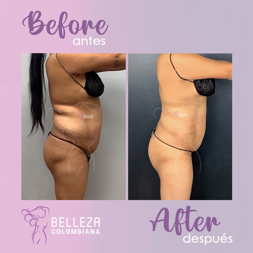 Facelift Before & After