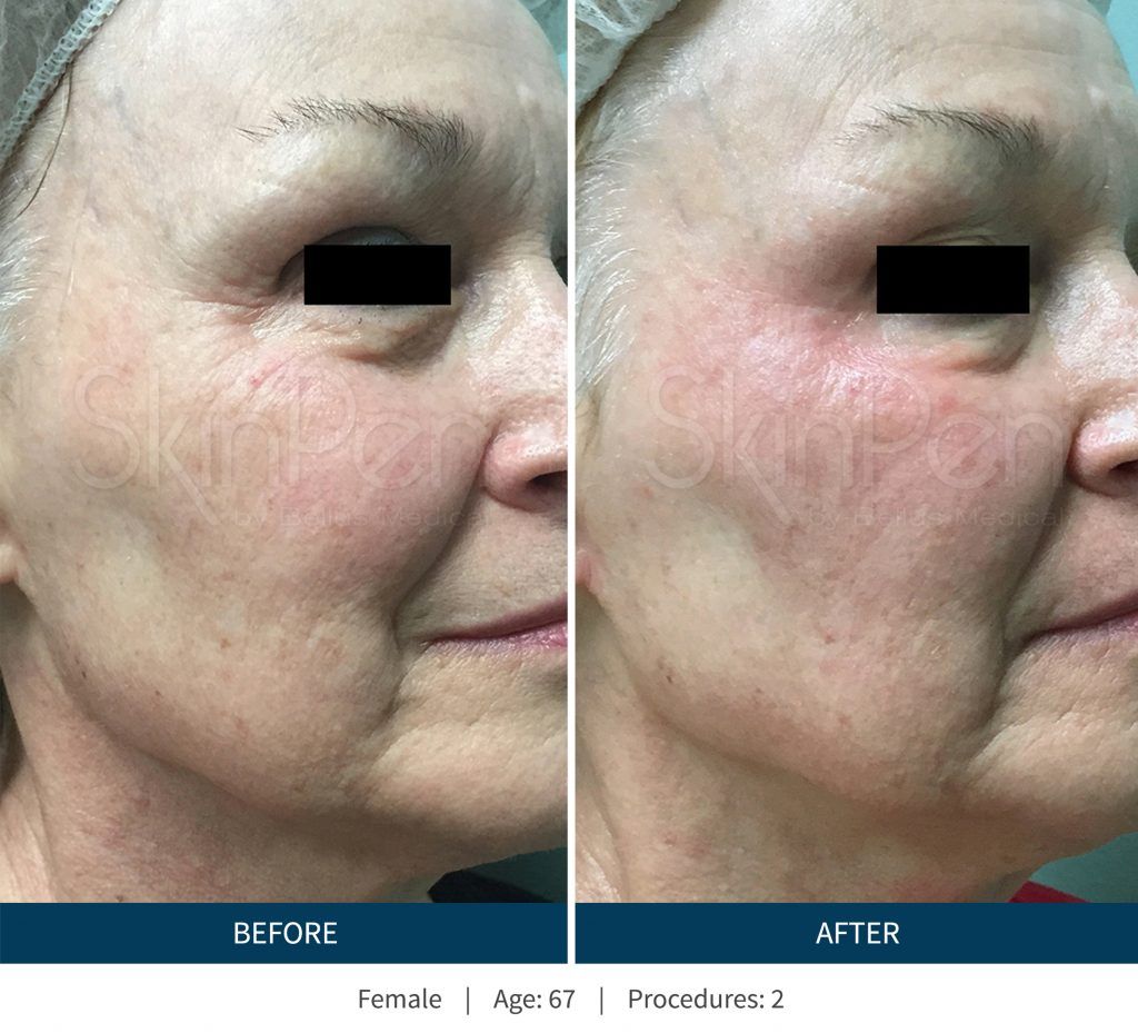 Microneedling Before & After
