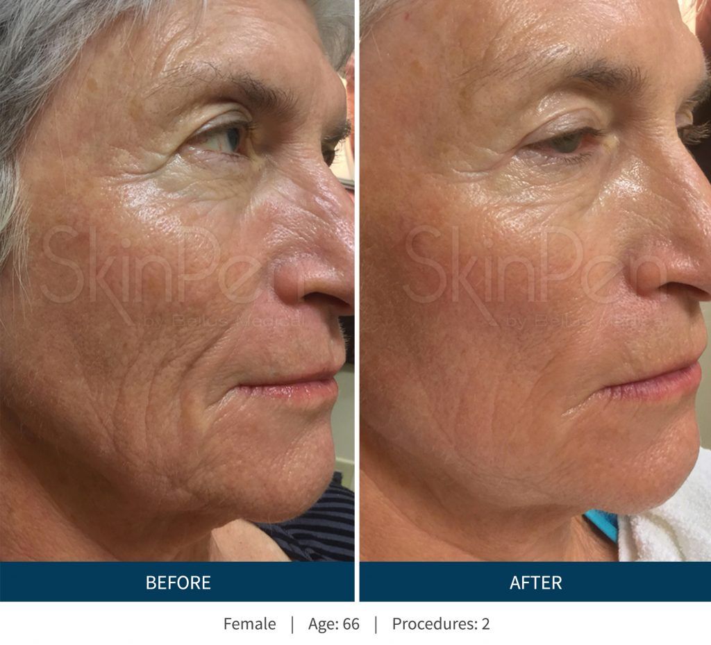 Microneedling Before & After