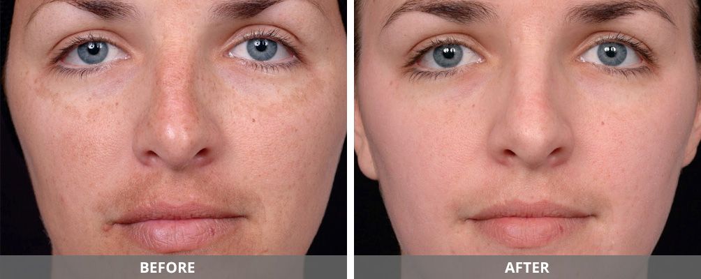 Chemical Peels Before & After