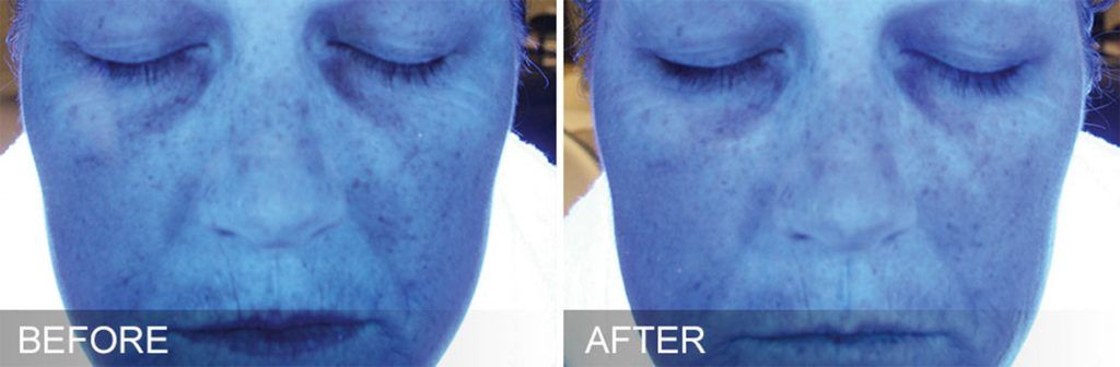 Hydrafacial Before & After