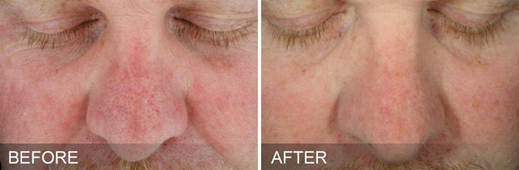 Hydrafacial Before & After